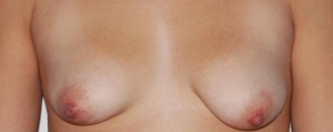 La asimetria de mamas o Cirugía de pechos asimétricos