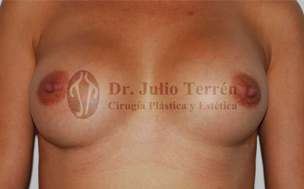 Foto resultado de la operacion de pechos desiguales Dr. Terrén