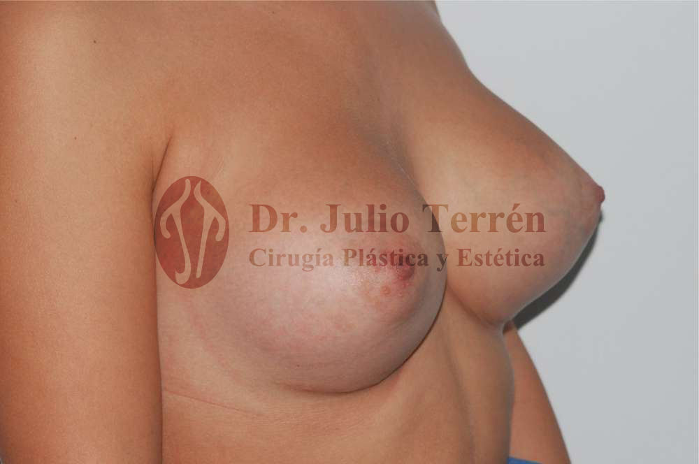 resultado de ka corrección de asimetria mamaria Valencia Dr. Terren caso4