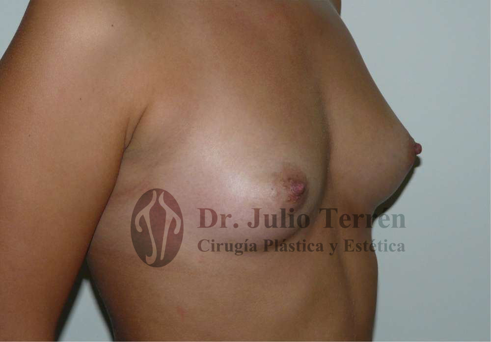 Foto del estado precio antes de la cirugia de asimetria de mamas