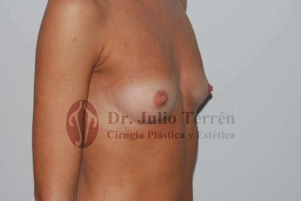 Foto Antes del aumento de senos en Valencia con el Dr. terrén