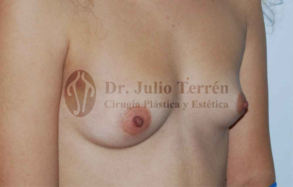Foto de mama tuberosa antes de la cirugía