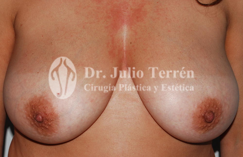 Foto del Antes de la cirugía de elvación de mamas