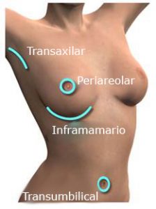 tipos aumento pecho: incision inframamaria, periareolar, transaxilar y por el ombligo 
