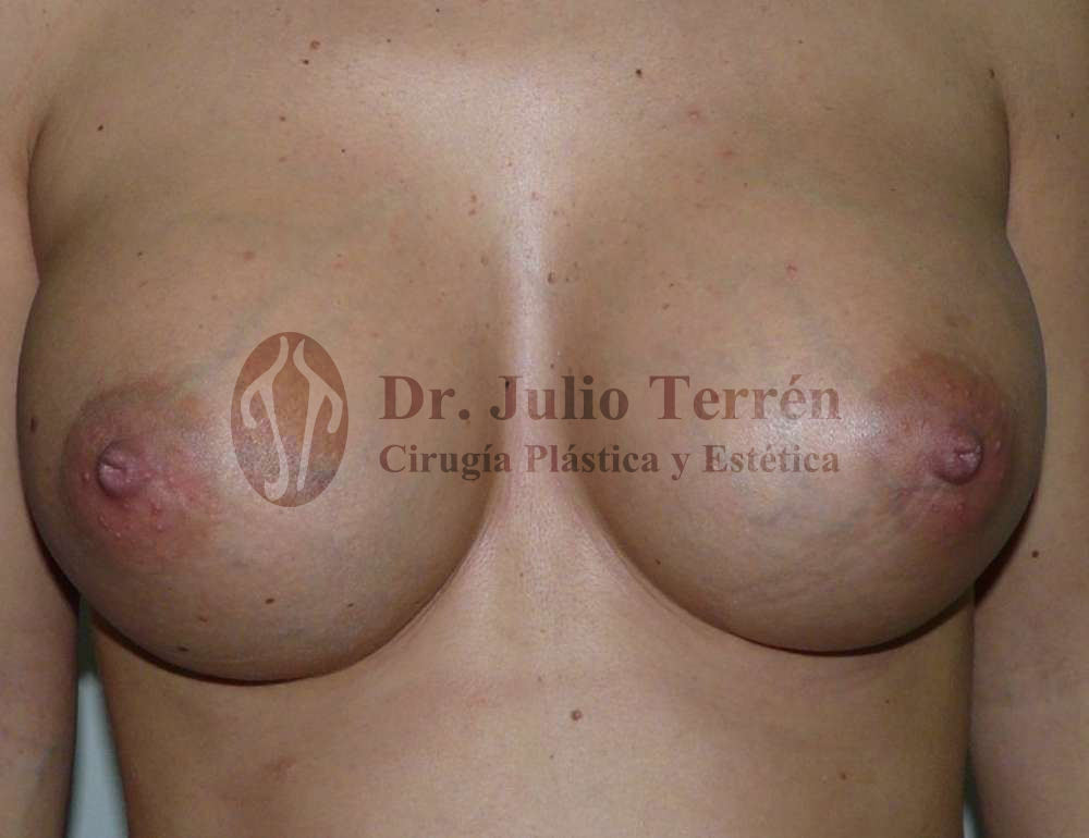 Resultados tras mamoplastia de aumento con Prótesis redondas